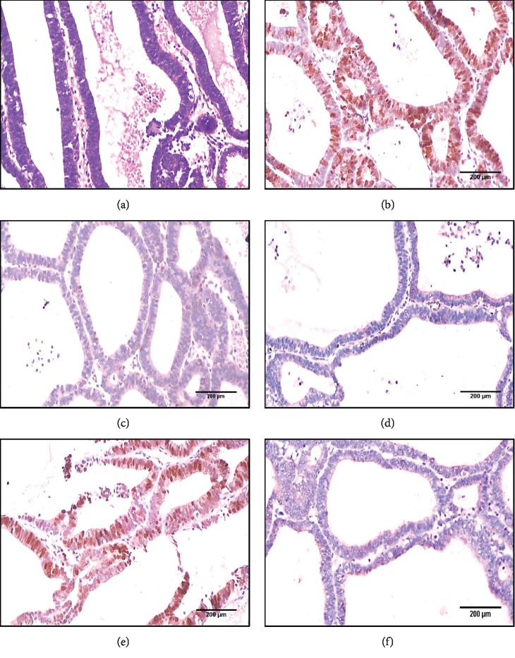 Could Obesity be a Triggering Factor for Endometrial Tubal Metaplasia to be a Precancerous Lesion?