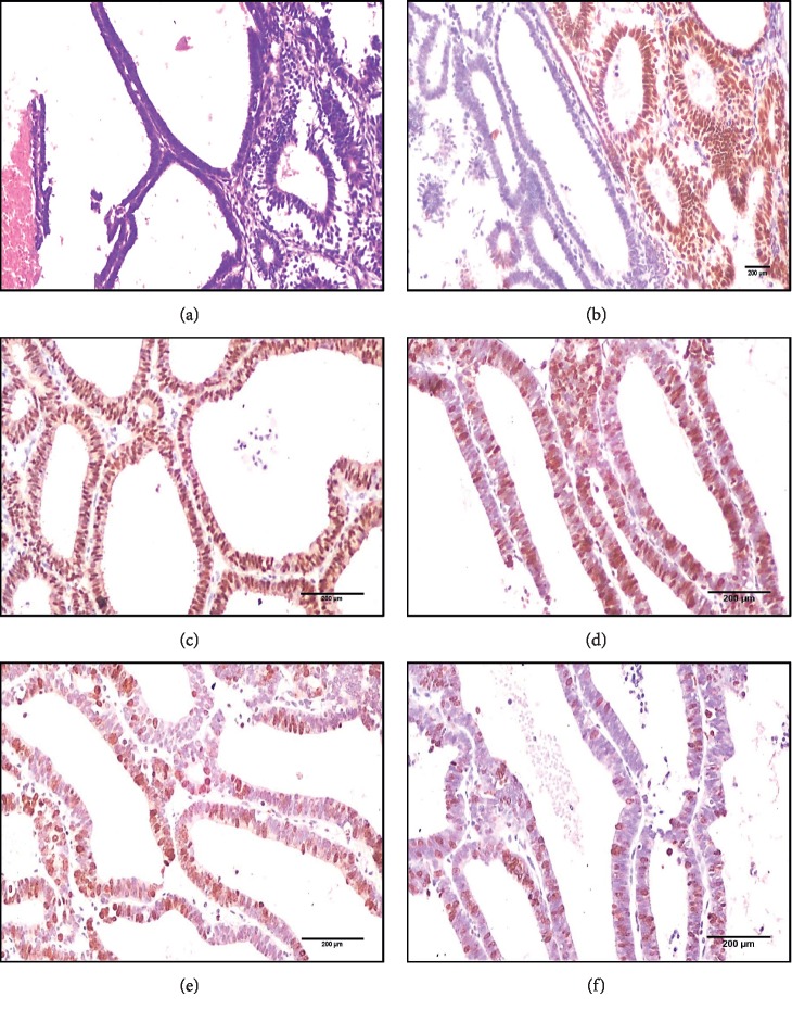 Could Obesity be a Triggering Factor for Endometrial Tubal Metaplasia to be a Precancerous Lesion?