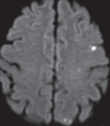 Into a Shaking Limbo: Case Report of a Nonneoplastic Limbic Encephalitis with Faciobrachial Dystonic Seizures and Parkinsonism.