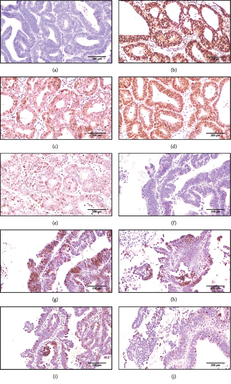 Could Obesity be a Triggering Factor for Endometrial Tubal Metaplasia to be a Precancerous Lesion?