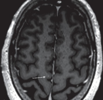 Into a Shaking Limbo: Case Report of a Nonneoplastic Limbic Encephalitis with Faciobrachial Dystonic Seizures and Parkinsonism.