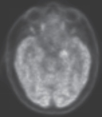 Into a Shaking Limbo: Case Report of a Nonneoplastic Limbic Encephalitis with Faciobrachial Dystonic Seizures and Parkinsonism.