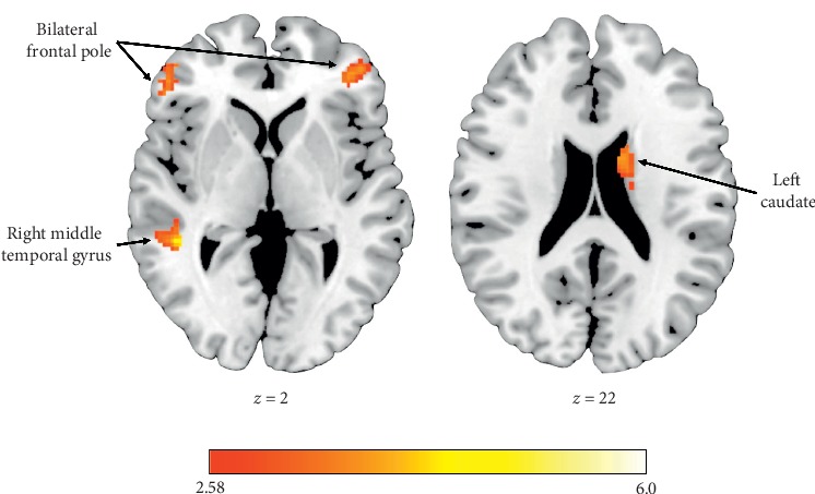 Neural Mechanisms of Vicarious Reward Processing in Adults with Autism Spectrum Disorder.