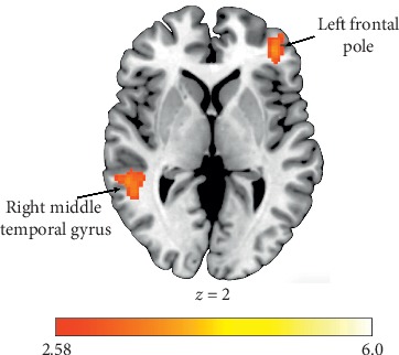 Neural Mechanisms of Vicarious Reward Processing in Adults with Autism Spectrum Disorder.