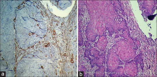 Myofibroblasts as important diagnostic and prognostic indicators of oral squamous cell carcinoma: An immunohistochemical study in normal oral mucosa, epithelial dysplasia, and oral squamous cell carcinoma.