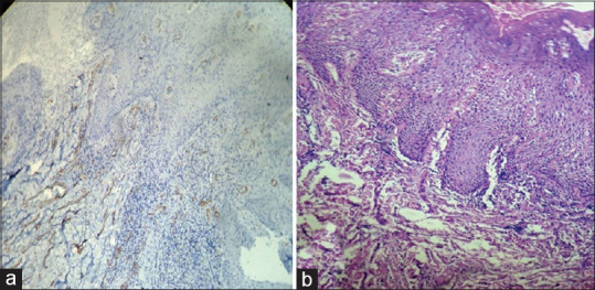 Myofibroblasts as important diagnostic and prognostic indicators of oral squamous cell carcinoma: An immunohistochemical study in normal oral mucosa, epithelial dysplasia, and oral squamous cell carcinoma.