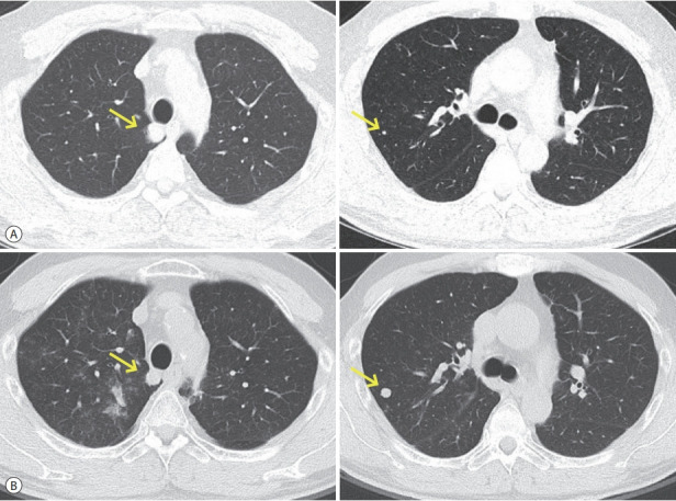 Successful Sequential Therapy Involving Regorafenib after Failure of Sorafenib in a Patient with Recurrent Hepatocellular Carcinoma after Liver Transplantation.