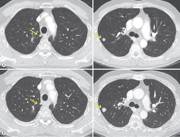 Successful Sequential Therapy Involving Regorafenib after Failure of Sorafenib in a Patient with Recurrent Hepatocellular Carcinoma after Liver Transplantation.