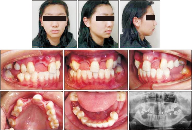 Protraction of mandibular molars through a severely atrophic edentulous space in a case of juvenile periodontitis.