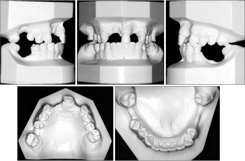 Protraction of mandibular molars through a severely atrophic edentulous space in a case of juvenile periodontitis.