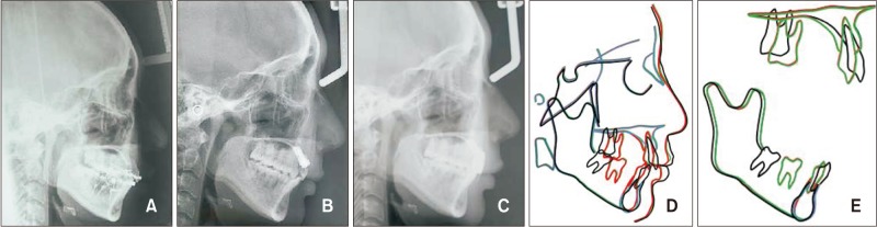 Protraction of mandibular molars through a severely atrophic edentulous space in a case of juvenile periodontitis.