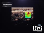 Diagnosis of Thyroid Nodule with New Ultrasound Imaging Modalities.