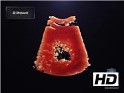 Diagnosis of Thyroid Nodule with New Ultrasound Imaging Modalities.