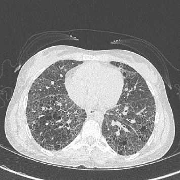 Lung Transplantation in a Patient with COPA Syndrome.