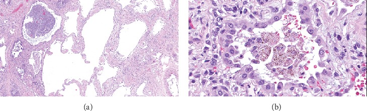 Lung Transplantation in a Patient with COPA Syndrome.