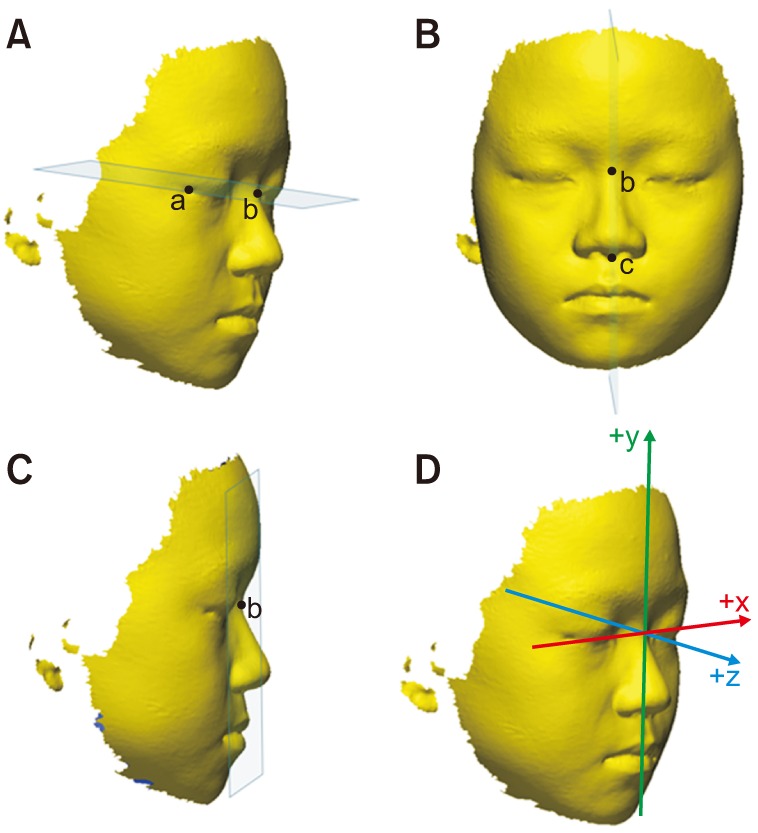 Short-term impact of microimplant-assisted rapid palatal expansion on the nasal soft tissues in adults: A three-dimensional stereophotogrammetry study.