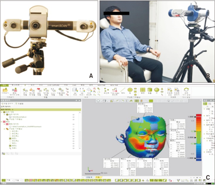 Short-term impact of microimplant-assisted rapid palatal expansion on the nasal soft tissues in adults: A three-dimensional stereophotogrammetry study.