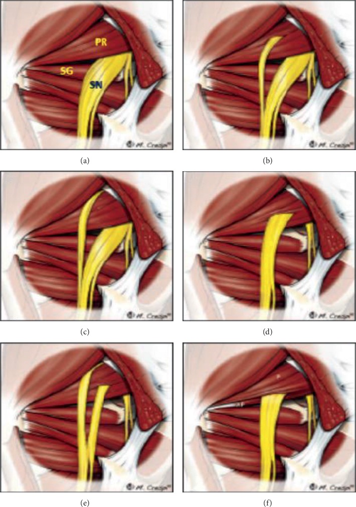 Composite Anatomical Variations between the Sciatic Nerve and the Piriformis Muscle: A Nepalese Cadaveric Study.