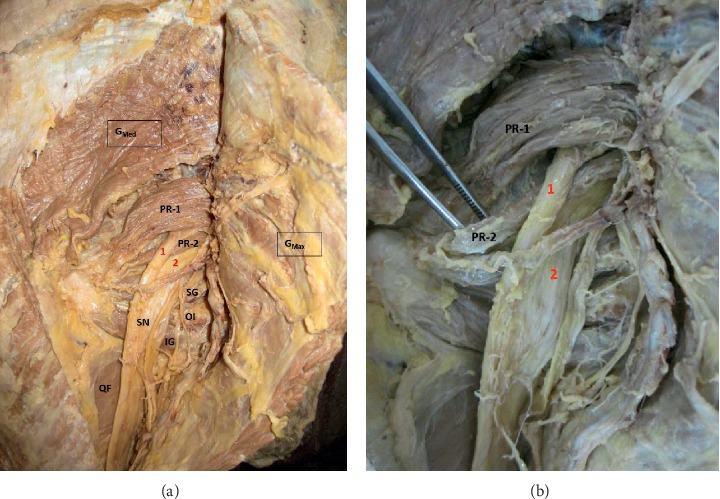 Composite Anatomical Variations between the Sciatic Nerve and the Piriformis Muscle: A Nepalese Cadaveric Study.