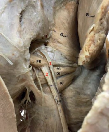 Composite Anatomical Variations between the Sciatic Nerve and the Piriformis Muscle: A Nepalese Cadaveric Study.