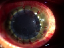 Hemophilia presenting as recurrent ocular hemorrhage.