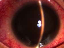 Hemophilia presenting as recurrent ocular hemorrhage.