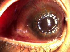 Hemophilia presenting as recurrent ocular hemorrhage.