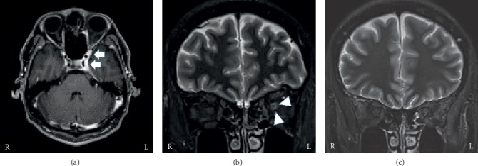 Clinical Features of Painful Ophthalmoplegia with a High-Intensity Ring Appearance around the Optic Nerve on MRI: A Case Series.