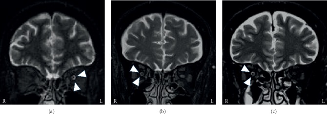 Clinical Features of Painful Ophthalmoplegia with a High-Intensity Ring Appearance around the Optic Nerve on MRI: A Case Series.