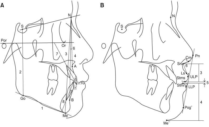 Changes in maximum lip-closing force after extraction and nonextraction orthodontic treatments.