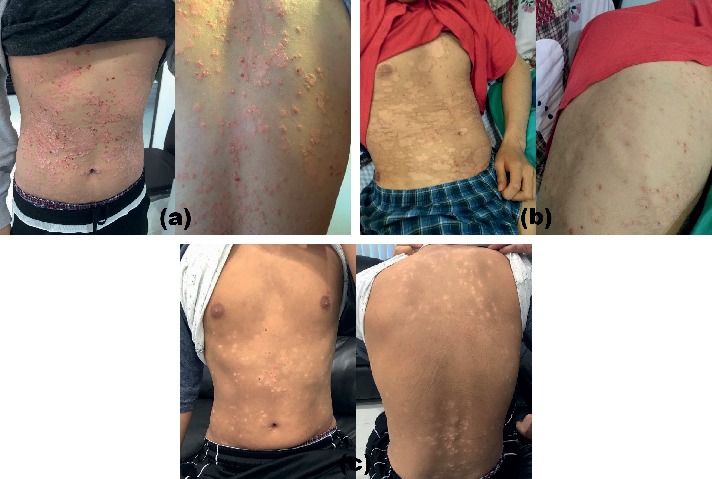 Successful Treatment of Plaque Psoriasis with Allogeneic Gingival Mesenchymal Stem Cells: A Case Study.