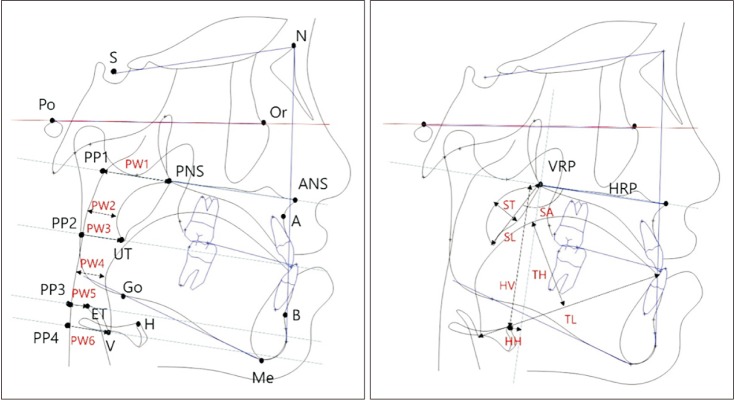 Immediate effects of mandibular posterior displacement on the pharyngeal airway space: A preliminary study.