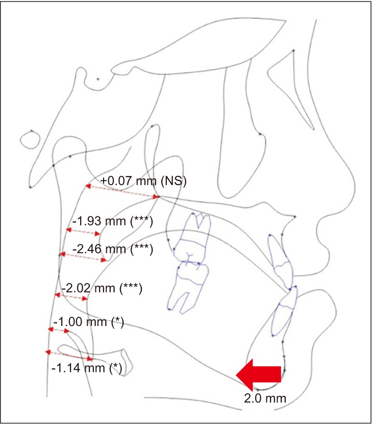 Immediate effects of mandibular posterior displacement on the pharyngeal airway space: A preliminary study.