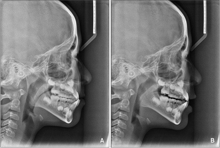 Immediate effects of mandibular posterior displacement on the pharyngeal airway space: A preliminary study.