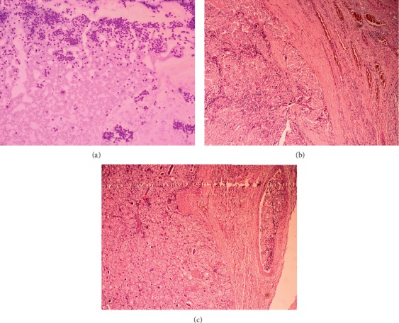 The Bethesda System for Reporting Thyroid Cytopathology: A Cytohistological Study.