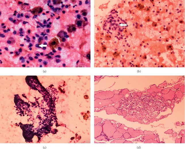 The Bethesda System for Reporting Thyroid Cytopathology: A Cytohistological Study.