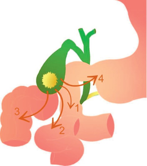 Rolling in the Deep: Imaging Findings and Diagnostic Pearls in Gallstone Ileus.