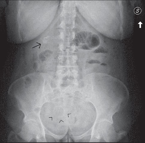 Rolling in the Deep: Imaging Findings and Diagnostic Pearls in Gallstone Ileus.