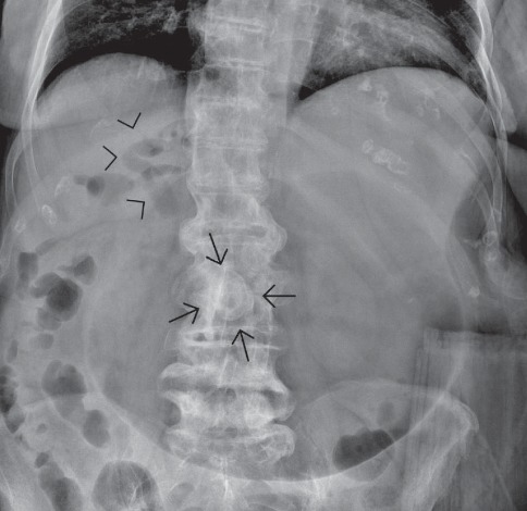 Rolling in the Deep: Imaging Findings and Diagnostic Pearls in Gallstone Ileus.
