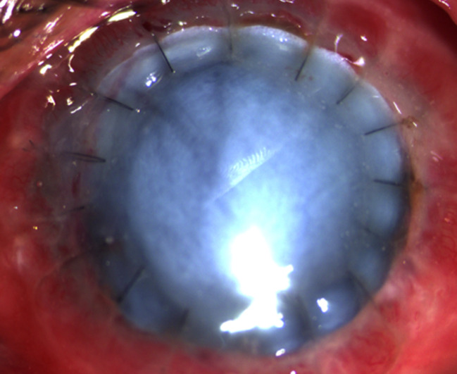 Large graft tectonic penetrating keratoplasty in a case of severe aspergillus keratitis.