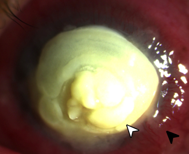 Large graft tectonic penetrating keratoplasty in a case of severe aspergillus keratitis.