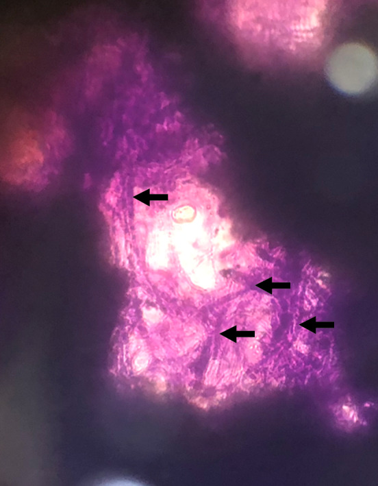 Large graft tectonic penetrating keratoplasty in a case of severe aspergillus keratitis.