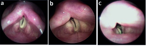 Endoscopic posterior cordotomy for treatment of dyspnea due to vocal fold immobility.