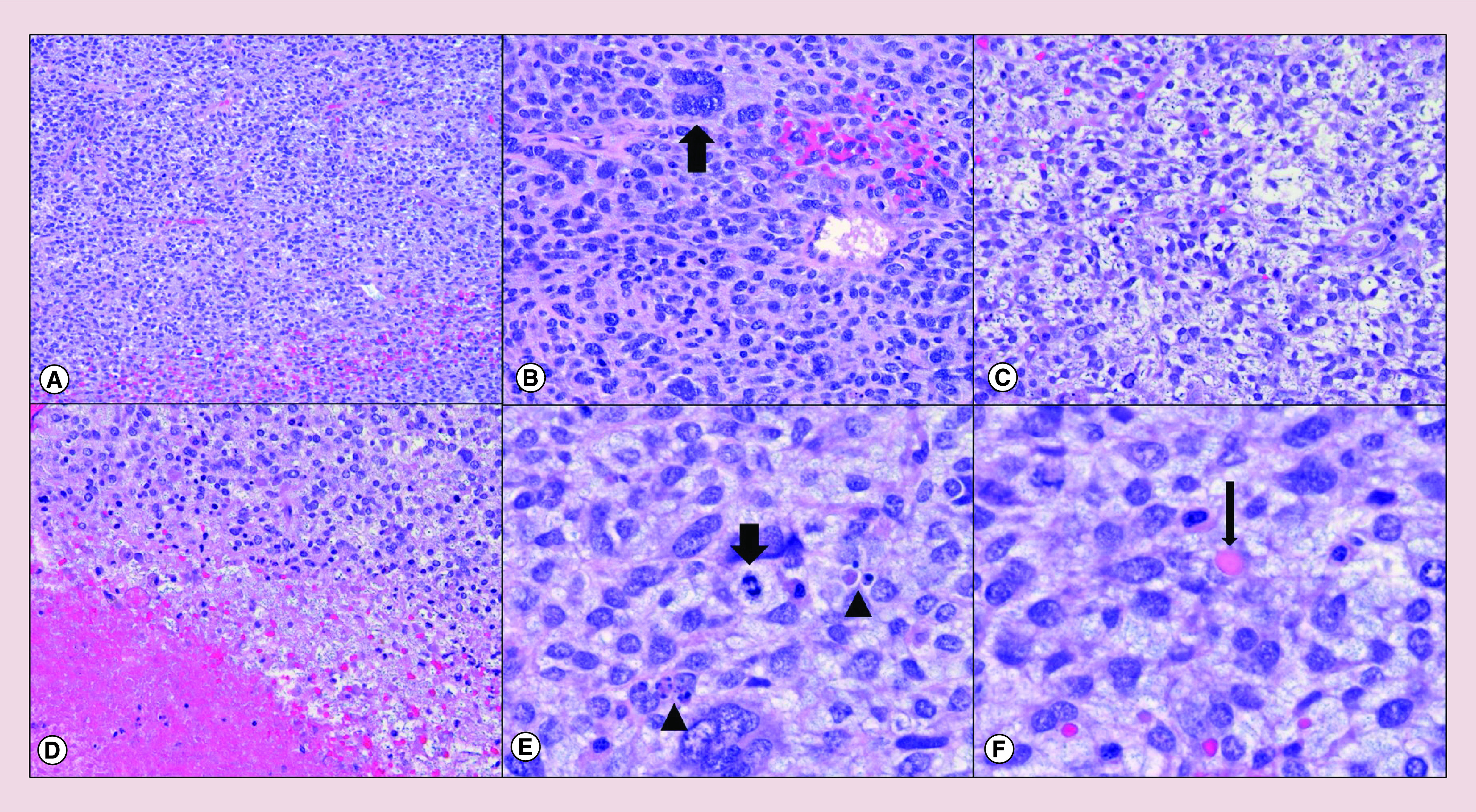 Hepatic mesenchymal hamartoma and undifferentiated embryonal sarcoma of the liver: a pathologic review.