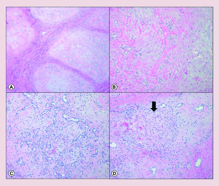 Hepatic mesenchymal hamartoma and undifferentiated embryonal sarcoma of the liver: a pathologic review.