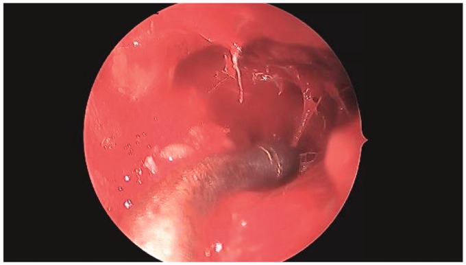 Extramedullary Hematopoiesis in the Sinonasal Cavity: A Case Report and Review of the Literature.