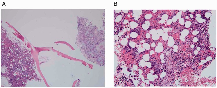 Extramedullary Hematopoiesis in the Sinonasal Cavity: A Case Report and Review of the Literature.