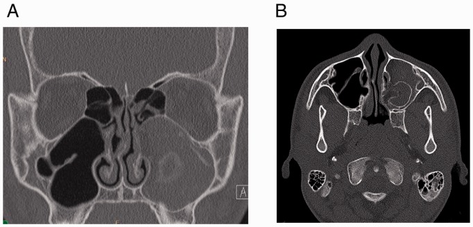 Extramedullary Hematopoiesis in the Sinonasal Cavity: A Case Report and Review of the Literature.