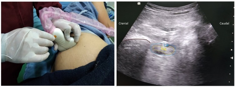 Ankle Surgery in a Patient with Acute Subdural Hematoma Under Combined Lumbar Plexus and Proximal Sciatic Nerve Block - A Case Report.