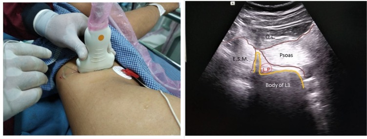 Ankle Surgery in a Patient with Acute Subdural Hematoma Under Combined Lumbar Plexus and Proximal Sciatic Nerve Block - A Case Report.